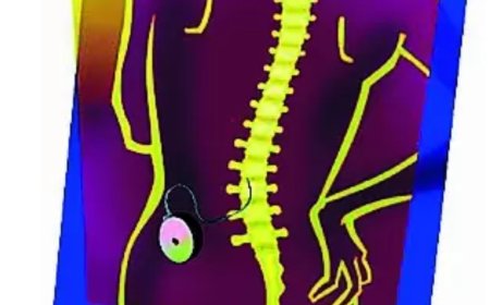 Health groups join patent war over spinal muscular atrophy drug