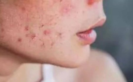 Why your acne scars won’t go away — science finds the real reason