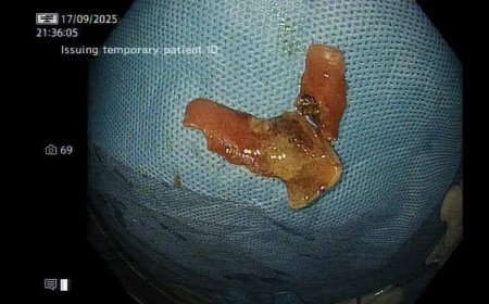 Laser saves man after denture gets stuck in food pipe