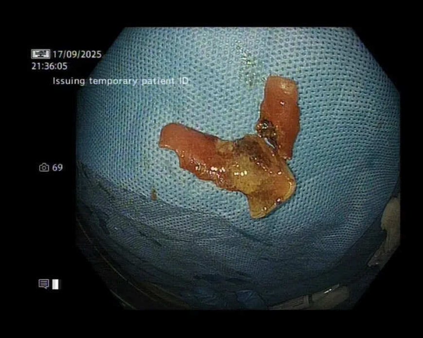 Laser saves man after denture gets stuck in food pipe